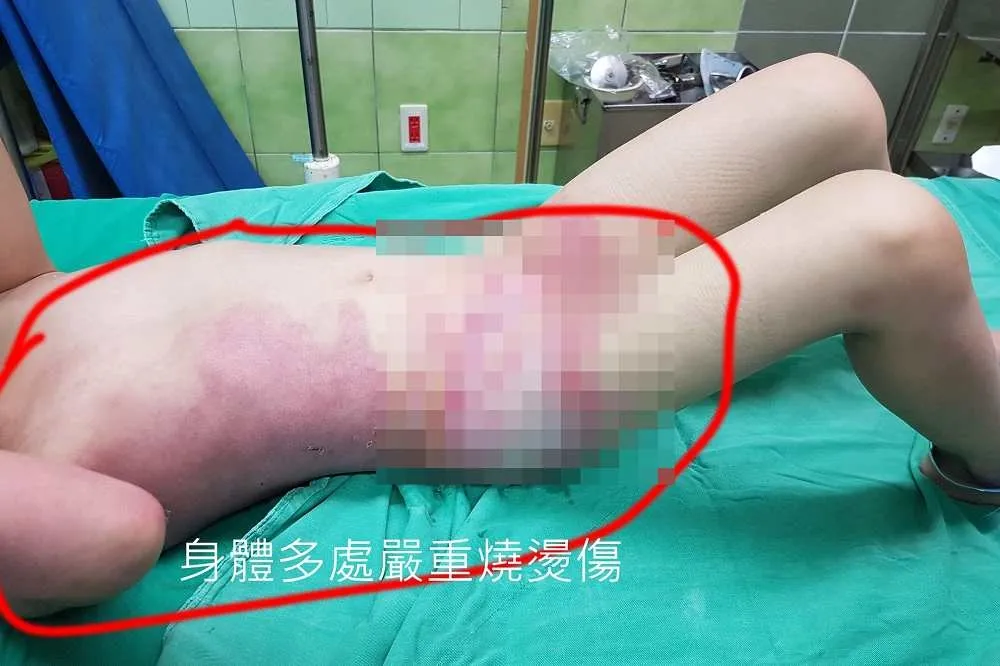 女兒遭燙傷一度命危　家長控幼兒園：第一時間只讓她自己沖水