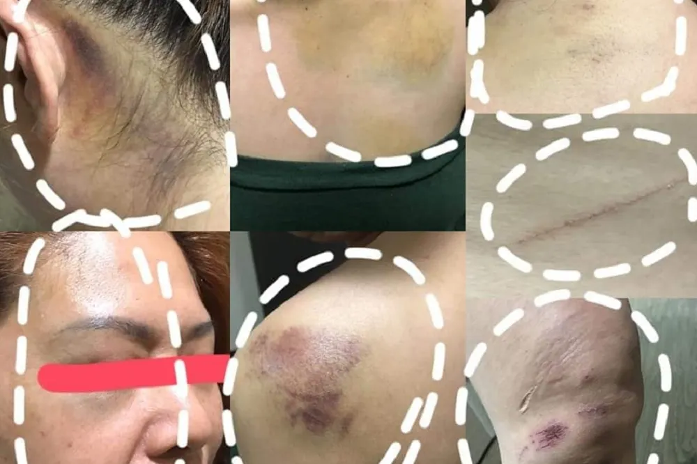 【又見渣男】拿刀割妻頸、踹斷6歲童肋骨　狠夫嗆：打妳孩子剛好而已