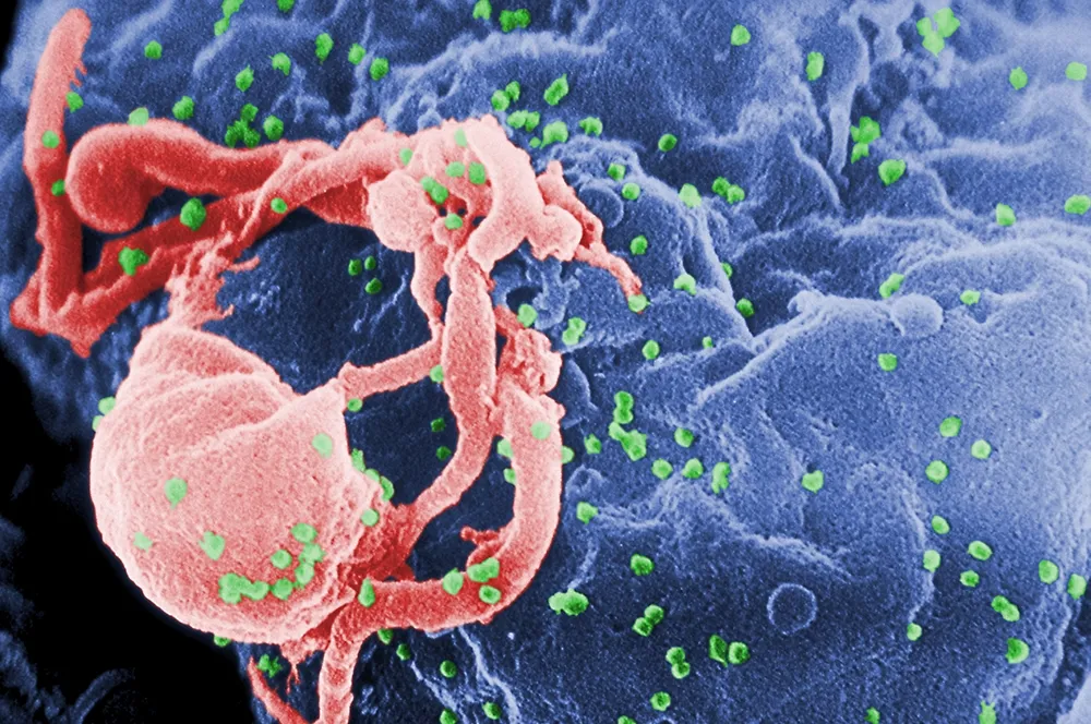 全球第二例　倫敦HIV帶原者接受幹細胞移植後「痊癒」