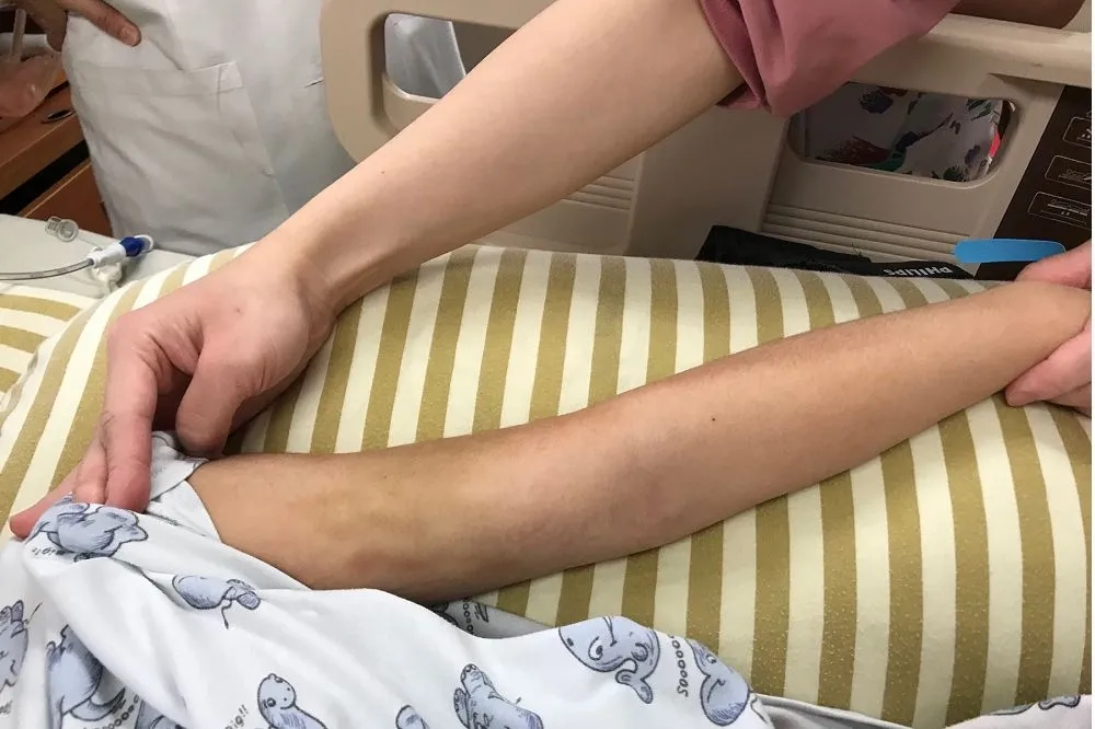 【可憐孩子渾身是傷】再傳虐童！　11歲女童顱內出血昏迷
