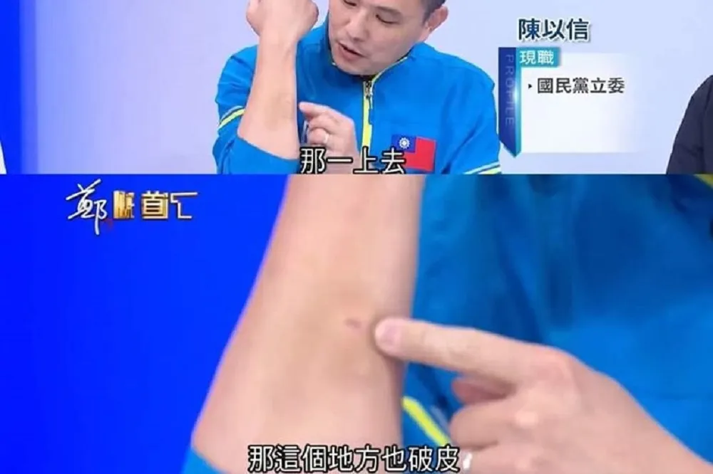 藍委秀「皮開肉綻」傷痕笑癱網路　王丹跟風PO照、陳亭妃嘆嬌滴滴的國民黨夠了沒