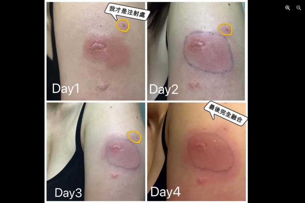 打莫德納寫「5天注射日誌」分享　護理師曝：接種後手臂紅腫、熱痛症狀