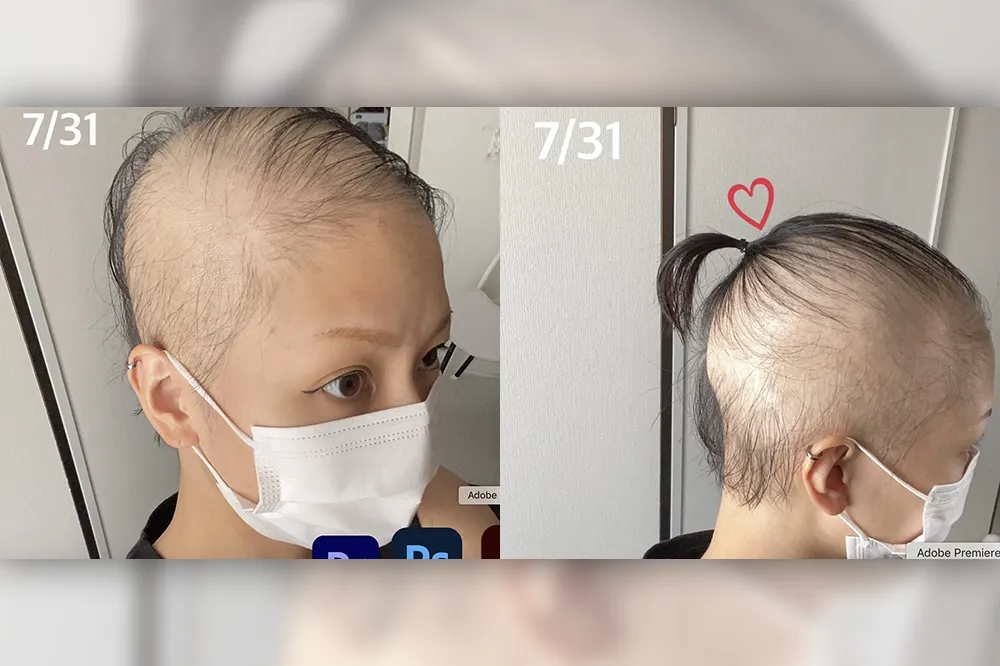 驚！櫻花妹打莫德納狂掉髮「慘變禿頭」　指揮中心這樣說