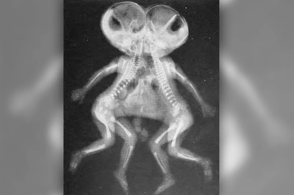 16世紀，人們認為胎兒異常是因為孕婦「胡思亂想」