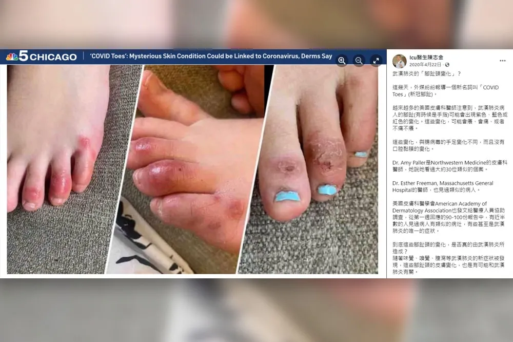 國外青少年出現「新冠腳趾」化膿　羅一鈞：病毒誘發皮膚免疫反應