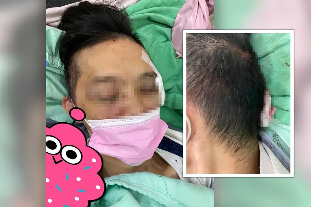 挖眼案翻版！只因提醒戴口罩　大夜男店員被打到眼窩破碎、腦震盪骨折