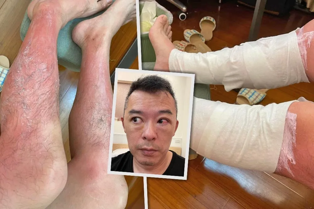 網紅「Andy老爹」用紫外線燈消毒　3小時後腿燙傷、眼角膜受損