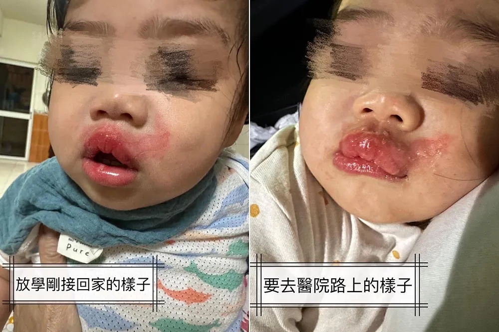 好狠心！托嬰中心1歲女童　疑被老師用高溫奶水燙成「香腸嘴」