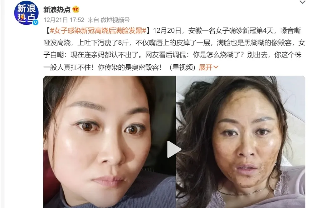 中國出現新冠變種病毒？　黑臉、黑舌頭、臉部脫皮怪症狀紛紛出籠